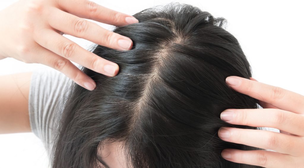 how to get rid of bald spots for a teenager